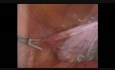 Management of a Giant Adnexal Cyst