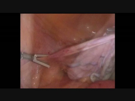 Management of a Giant Adnexal Cyst