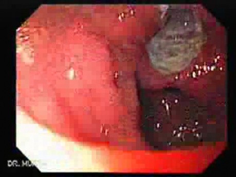 Two Ulcers in a Cirrhotic Patient - A Big Ulcer at the Antrum