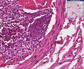 Lung - tumor Emboli