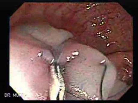 Colonoscopic Polypectomy (13 of 23)