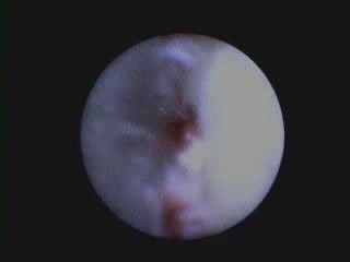Removal Of Enamel Projection