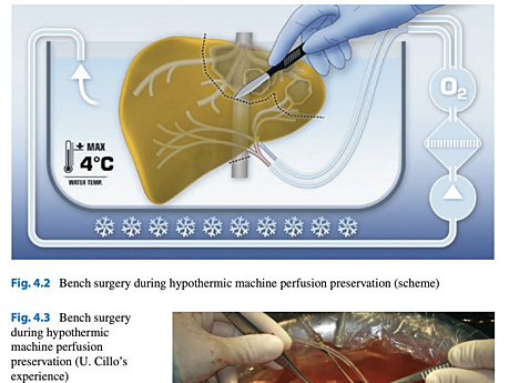 Hepatbiliary Surgery