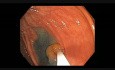Colonoscopy Channel - How To Perform EMR - Lesion B