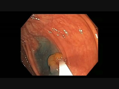 Colonoscopy Channel - How To Perform EMR - Lesion B