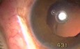 Post Vitrectomy & Lensectomy Site - Transciliary Filtration
