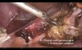 Tip and tricks. Safe hysterectomy in case of huge cervico isthmic myoma