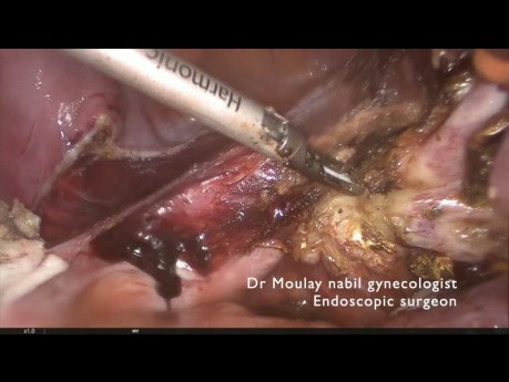 Tip and tricks. Safe hysterectomy in case of huge cervico isthmic myoma