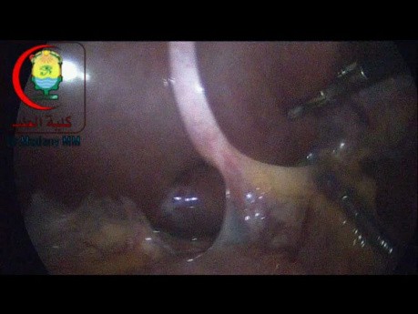 Is it Also a Portal Vein Anomaly in the next Successive Case or What's the Issue Else?