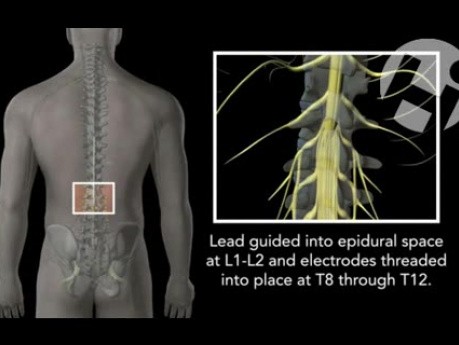 Lumbar - Spinal Cord Stimulator Placement