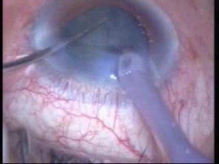 Phacoemulsification - Stop And Chop Technique