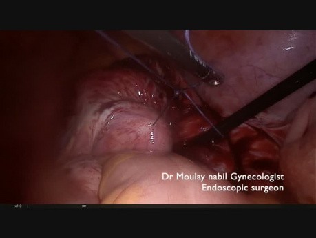 How to Over Rule the Indications of Laparoscopic Myomectomy - Tips & Tricks