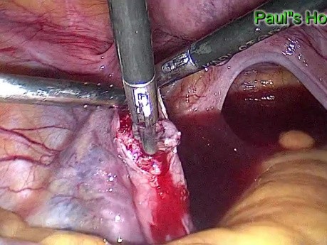 Ectopic Pregnancy - Salpingectomy by Use of Laparoscopic Surgery
