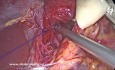 Antireflux Surgery: Intraabdominal Esophageal Length, Hiatal Closure, Cruroplasty