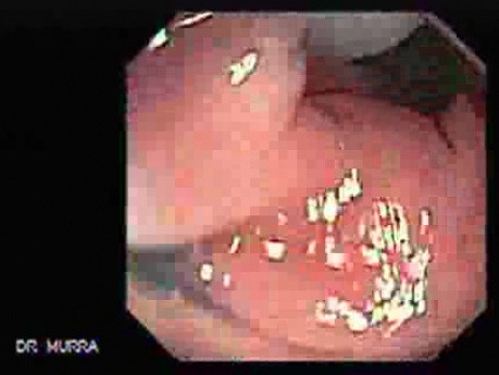 Colonoscopic Polypectomy (12 of 23)
