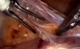 Total Laparoscopic Hysterectomy - Standard Technique