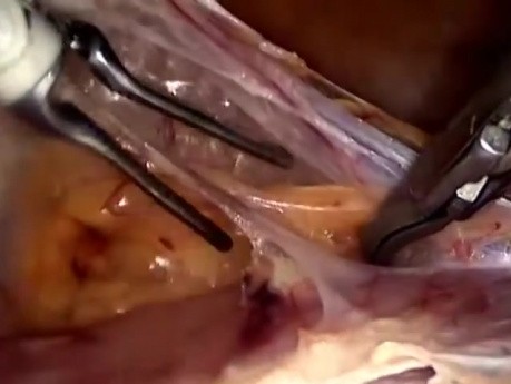 Total Laparoscopic Hysterectomy - Standard Technique
