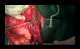 Cytoreductive Procedure for Ovarian Granulosa Tumor