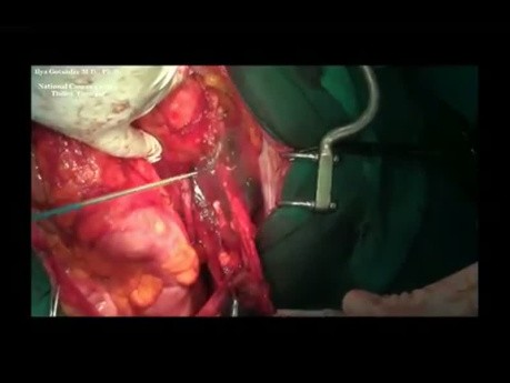 Cytoreductive Procedure for Ovarian Granulosa Tumor