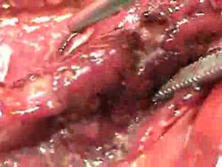 Multiple Rectal Ulcers (57 of 110)