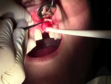 Flap Design & Pilot Hole - Implant Placement #9