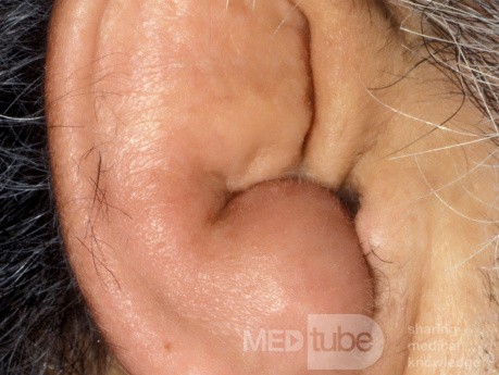 Idiopathic Cystic Chondromalacia of the Pinna