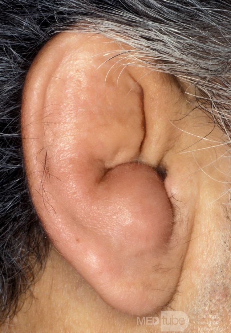 Idiopathic Cystic Chondromalacia of the Pinna