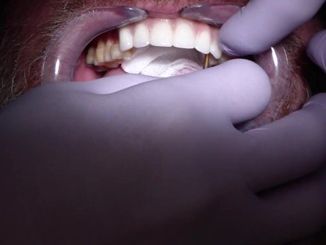 Implant Supported Hybrid Denture - Delivered
