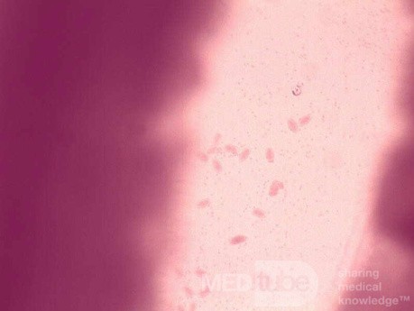 Colonoscopy observing a trichuris in the cecum (6 of 8)