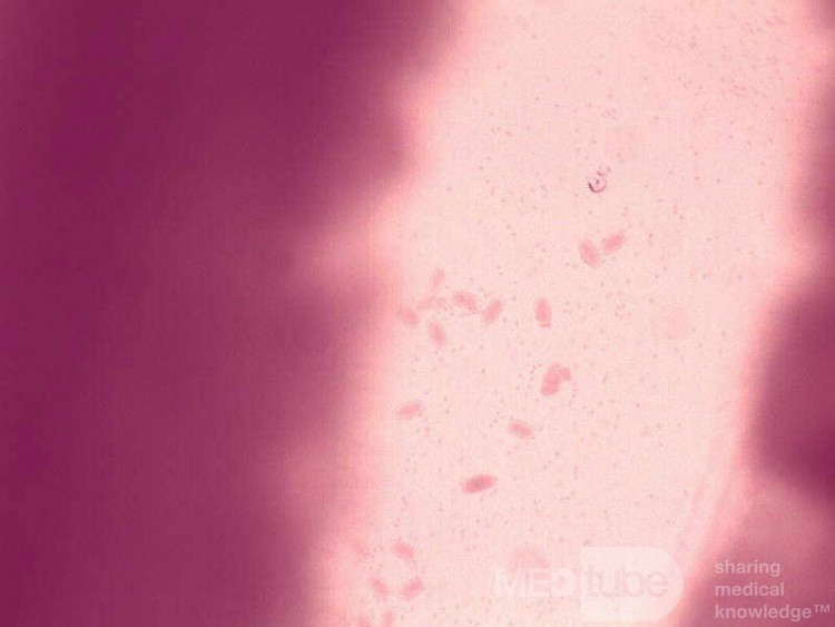 Colonoscopy observing a trichuris in the cecum (6 of 8)