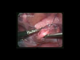 Urinary Bladder Injury Due To The Trauma Of Lower Abdomen And Groin Region