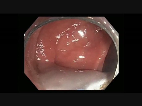 Colonoscopy - Descending Colon EMR of a Prior Failed SSA Resection