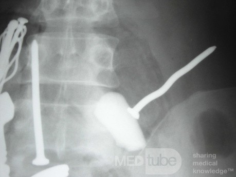Multiple Foreign bodies in the GI tract (10 of 12)