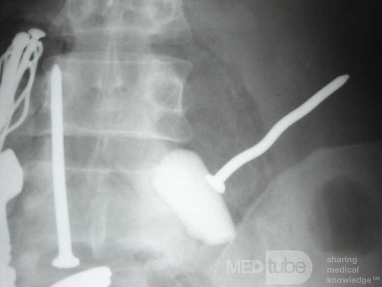 Multiple Foreign bodies in the GI tract (10 of 12)