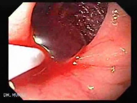 Duodenal Ulcer and Bleeding (18 of 23)