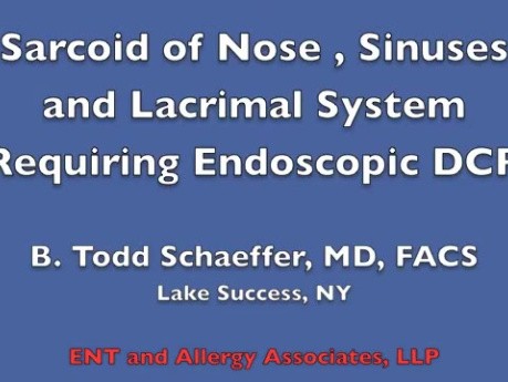Endoscopy of Nasal Cavity and Sinuses