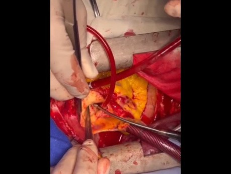 Modified Cabrol Technique for Patient with Ascending Aorta Dissection as Well as Coronary Ostia Dissection 