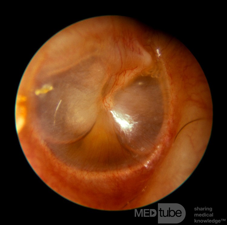 Serous Otitis Media Air Fluid Level [right ear]