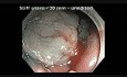 Colonoscopy Channel - EMR Of Serrated Polyp In Transverse Colon