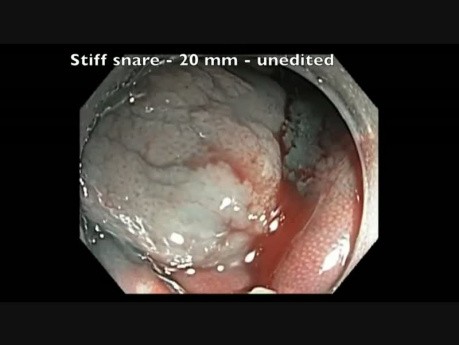 Colonoscopy Channel - EMR Of Serrated Polyp In Transverse Colon