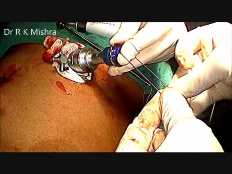 Laparoscopic Cholecstectomy