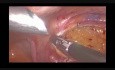 Radical Laparoscopic Right Hemicolectomy With D3 Lymph Node Dissection And Intra-corporeal Anastomosis For Caecum Cancer - How I Do It