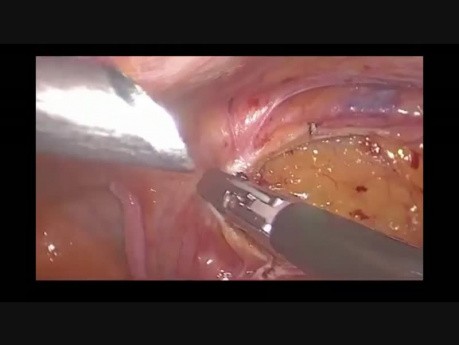 Radical Laparoscopic Right Hemicolectomy With D3 Lymph Node Dissection And Intra-corporeal Anastomosis For Caecum Cancer - How I Do It