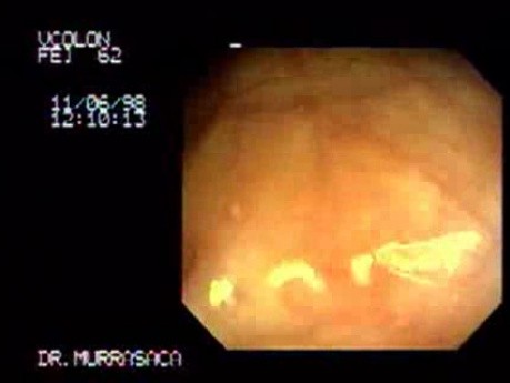 Amebic Colitis 2