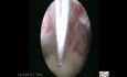 Hysteroscopic Exasion Of Polyp Mechanical