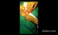 Mesentric Cyst Surgery