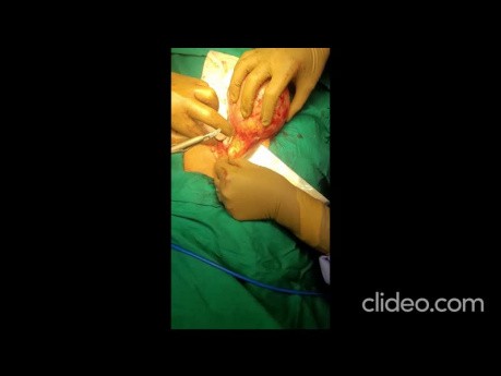 Mesentric Cyst Surgery