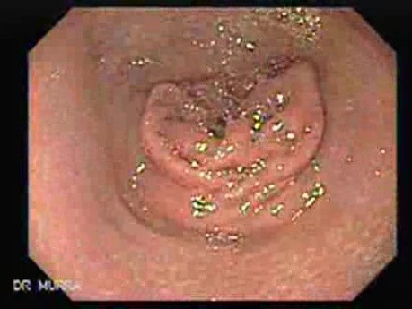 Ovarian Carcinoma with Gastric and Duodenal Metastases  - Closer Look at the Gastric Fundus