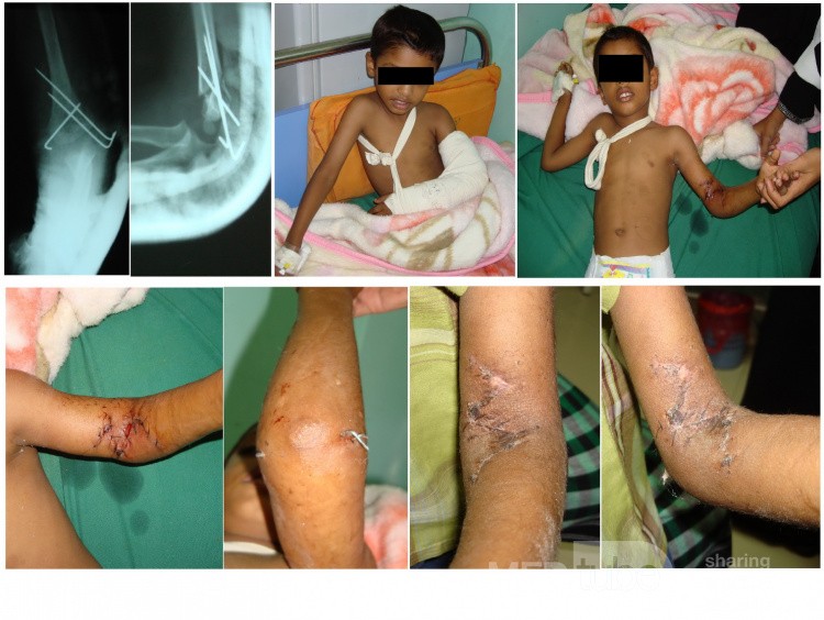 Compound SC# of Humerous with neurovascular injury 2