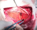 Acute Spontaneous Subdural Hemorrhage in the Subdural Space
